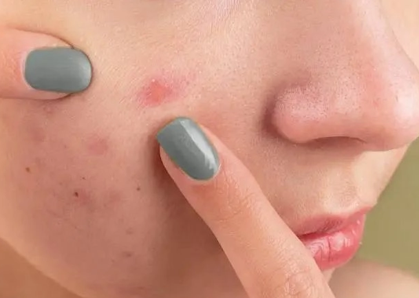 The 4 Surprising Acne Triggers 99% of People Overlook