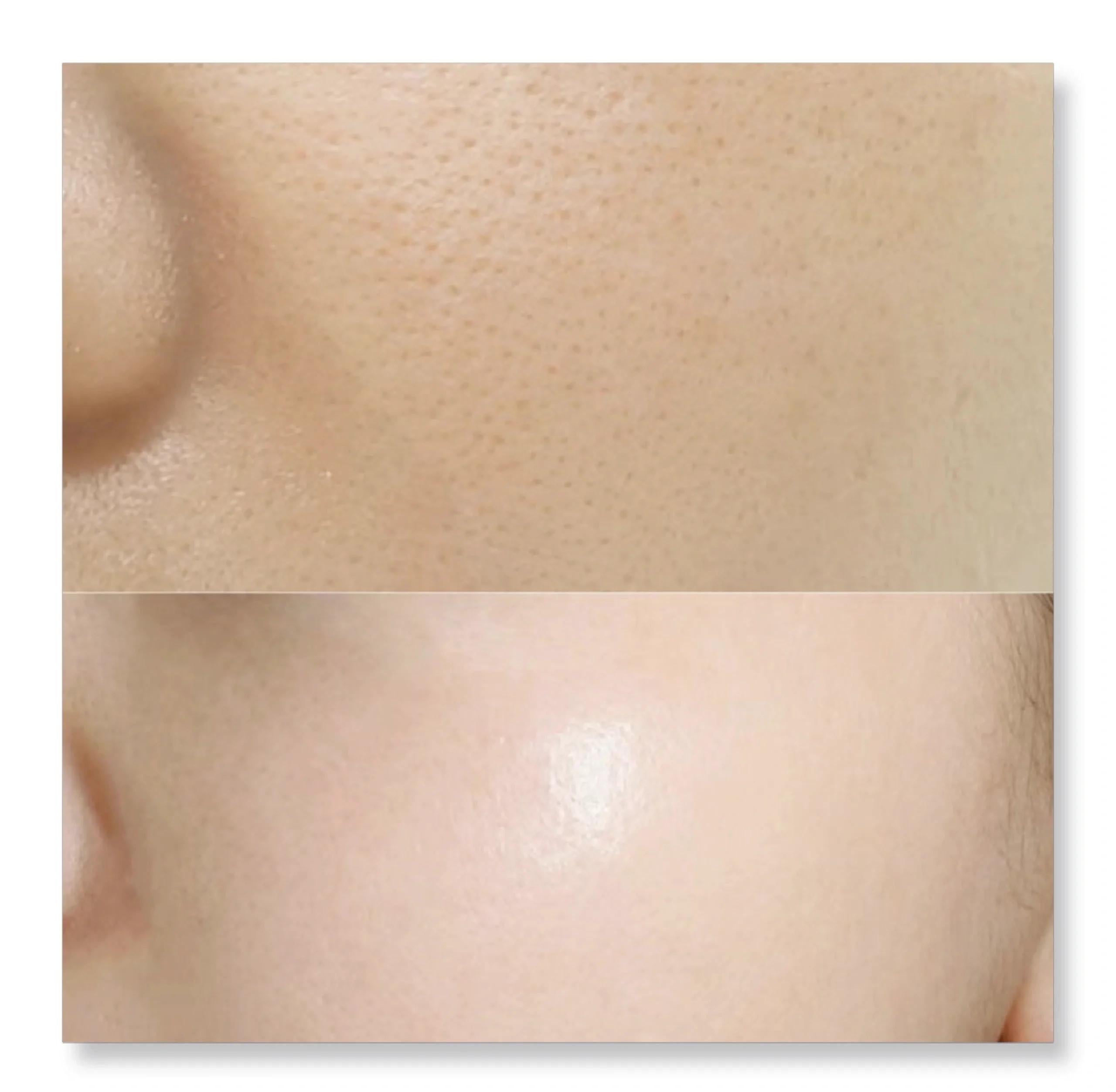 The Great Pore Escape: How to Shrink Those Craters