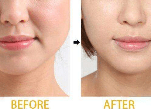 Why Do Chinese Women Hate Nasolabial Folds? Science-Backed Solutions to Defy Them