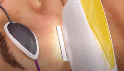 Home IPL (Photon) Devices