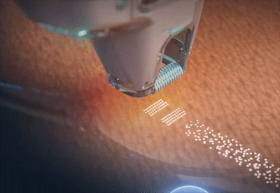 Fractional Laser Devices