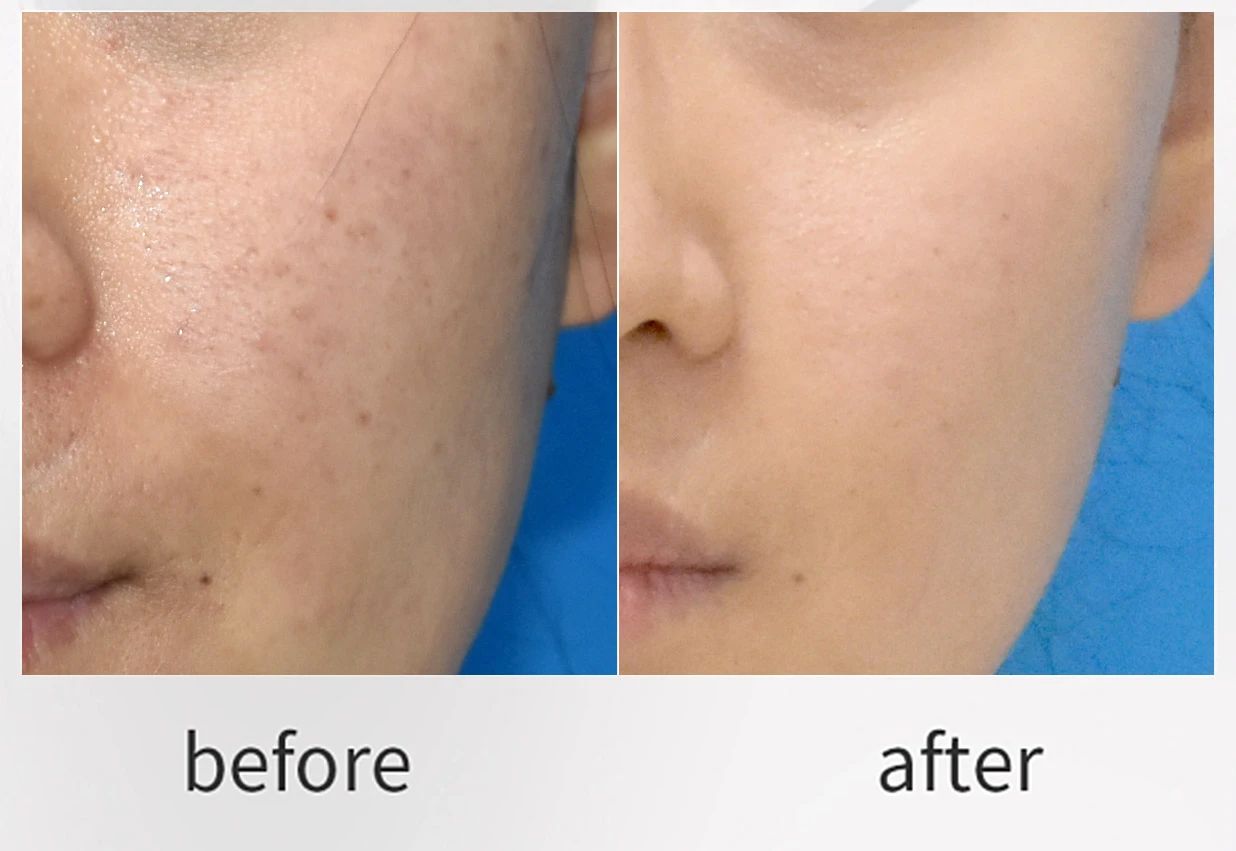 Works via Mesotherapy